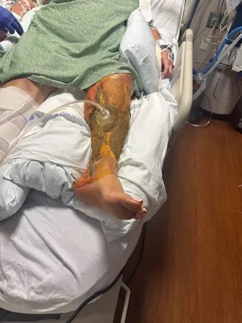 [뉴시스] 비브리오 패혈증균에 감염돼 수술을 받은 미국 여성 제네비브 갤러거의 다리 모습. (사진=갤러거·뉴욕포스트) 2025.9.10 *재판매 및 DB 금지