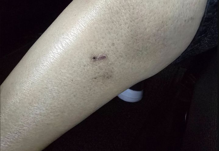 [서울=뉴시스] 개에 물린 상처 자국 (사진=온라인 커뮤니티 캡처) 2025.09.18 *재판매 및 DB 금지