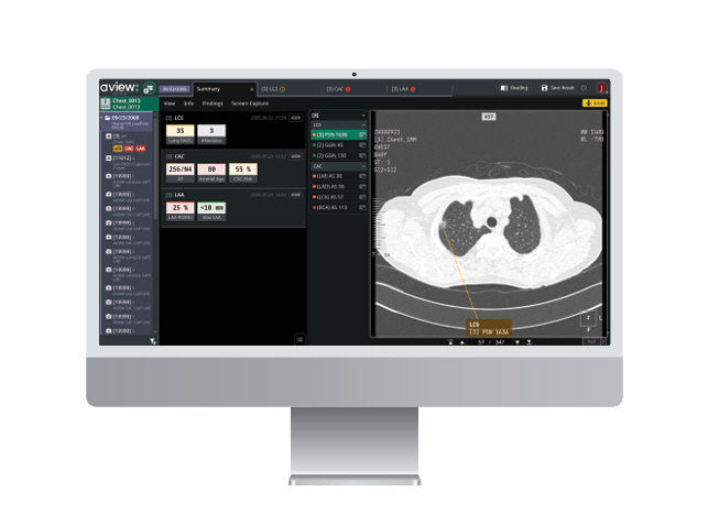 [서울=뉴시스] 코어라인소프트는 오는 24일부터 27일까지 서울 코엑스에서 개최되는 대한영상의학회 학술대회(KCR 2025)에서 의료 인공지능(AI) '에이뷰 (AVIEW) 2.0'을 시연한다고 18일 밝혔다. (사진=코어라인소프트 제공) 2025.09.18. photo@newsis.com *재판매 및 DB 금지