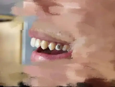 [뉴시스]중국에서 인공치관(크라운) 맞춤 제작 기술을 활용해 치아 표면에 글자를 새기는 '치아 문신'이 젊은 층 사이에서 인기를 끌고 있다.(사진= 광명망 캡쳐).2025.09.18 *재판매 및 DB 금지