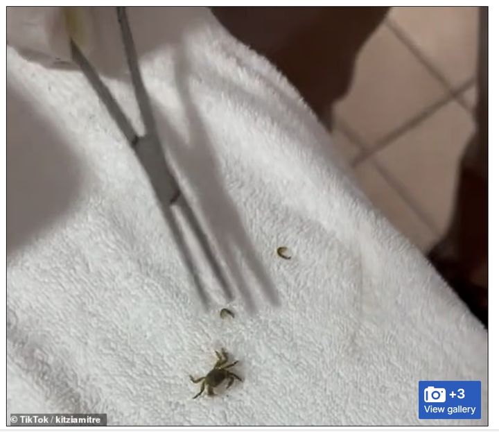 [서울=뉴시스]페드로 귀에서 나온 게의 모습.(사진: 데일리메일 캡처) 2025.09.19.