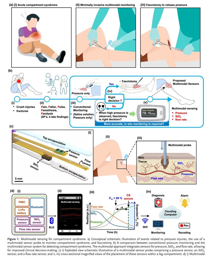 [서울=뉴시스] 연구 관련 모식도. a) 구획 증후군과 압력 부상 발생에 따른 치료 흐름의 도식화 그림, b) 압력 해소 위해 근막절개술을 시행하는 다중 모드 감지 프로브의 사용을 나타내는 그림, c) 구획 증후군 감지를 위한 멀티 모달 센서 프로그램과 기존의 구획압 측정 모니터링 시스템 비교 그림, d) 압력과 조직 산소 포화도, 혈류량 센서로 구성된 멀티모달 감지 프로브의 확대 도식도와 센서를 다리 구획 내에 배치한 단면도, e) 구획 증후군 감지를 위한 멀티모달 센서 시스템의 도식도. (사진=경희대 제공) 2025.09.19. photo@newsis.com *재판매 및 DB 금지