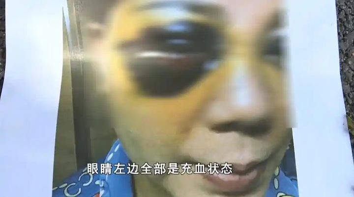 [뉴시스]2022년 창사에 거주하는 50대 여성 B 씨 역시 성형수술 이후 얼굴 전체가 멍과 충혈로 뒤덮이는 부작용을 겪었다.(사진=환구망 캡쳐).2025.09.19 *재판매 및 DB 금지