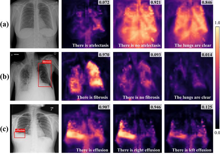 [서울=뉴시스] 의료 인공지능(AI) 전문기업 딥노이드는 딥노이드 연구팀의 흉부 엑스레이(X-ray) 영상 분석 기술 'RadZero' 연구 논문이 국제 AI 학술대회 ‘NeurIPS(Neural Information Processing Systems) 2025’에서 채택됐다고 23일 밝혔다. (사진=딥노이드 제공) 2025.09.23. photo@newsis.com *재판매 및 DB 금지