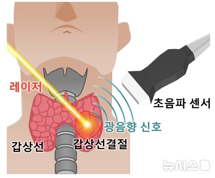 [포항=뉴시스] 갑상선 결절에 레이저로 광음향 신호를 발생시키고, 초음파 센서로 광음향 신호를 획득하는 모식도. (사진=포스텍 제공) 2025.09.23. photo@newsis.com 