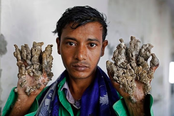 [서울=뉴시스] 희귀질환 '나무인간증후군(Tree Man Syndrome)' 환자들이 전 세계적으로 극소수 보고되고 있다. 사진은 해당 질환의 환자 아불 바잔다르의 모습. (사진 = 데일리메일 캡처) 2025.09.24. *재판매 및 DB 금지