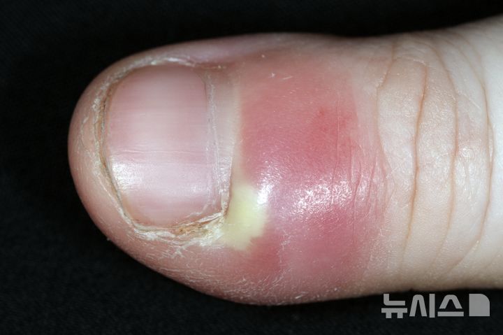 [서울=뉴시스] 조갑주위염 이미지. (사진= 이대목동병원 제공)