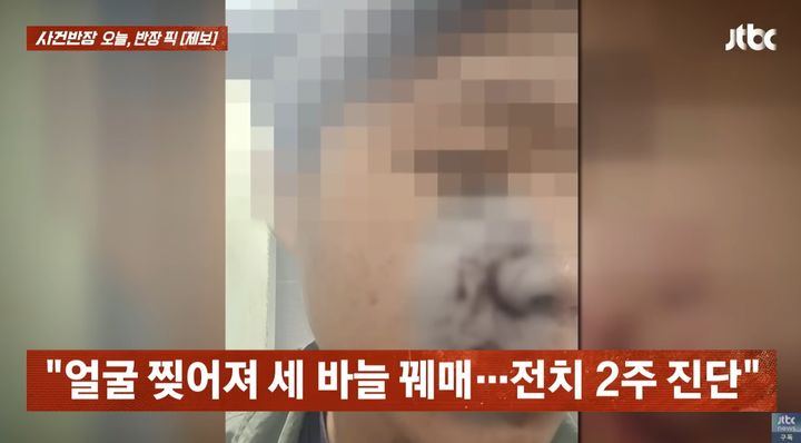 [서울=뉴시스] 싸움을 말리는 과정에서 A씨는 얼굴이 찢어져 세 바늘을 꿰매는 등 전치 2주의 부상을 입었다. (사진=JTBC '사건반장' 갈무리) 2025.09.25 *재판매 및 DB 금지