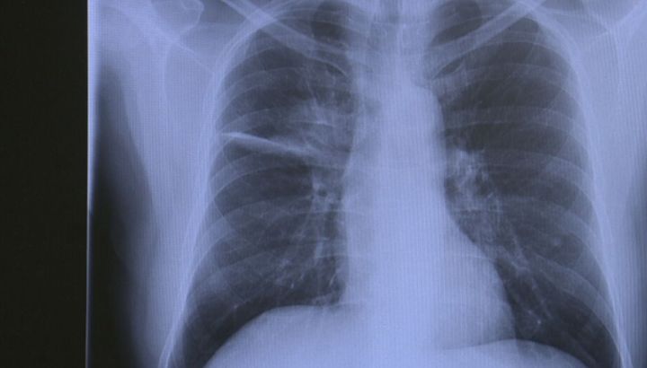 [서울=뉴시스] 공개된 카미지 박사의 흉부 엑스레이 사진. (사진 = CBS콜로라도 캡처) 2025.09.30. *재판매 및 DB 금지