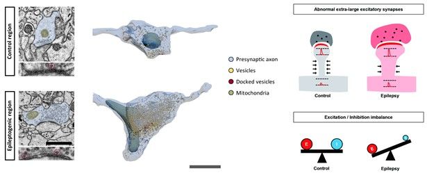 [대구=뉴시스] 뇌전증 유발 영역의 비정상적 시냅스 크기 증가 그림 설명. (사진=한국뇌연구원 제공) 2025.09.30. photo@newsis.com *재판매 및 DB 금지