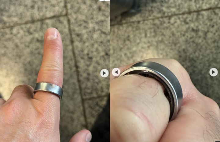 [서울=뉴시스]배터리가 부풀어 오르면서 손가락에 꽉 낀 갤럭시링의 모습. (사진출처: 다니엘 로타르 엑스)2025.09.30.