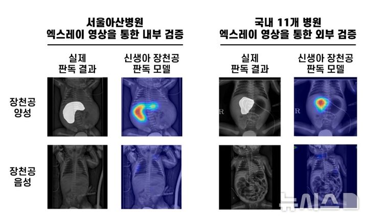 [서울=뉴시스] 신생아 장천공 인공지능 판독 모델은 복강 내 공기가 차 있는 영역 등을 정확히 식별하며 장천공 여부를 판별했다. (사진= 서울아산병원 제공)