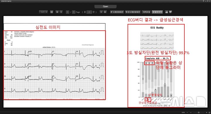 [서울=뉴시스] AI(인공지능) 심전도 분석 솔루션 'ECG 버디'를 사용한 그래프 모습. (사진= 분당서울대병원 제공)
