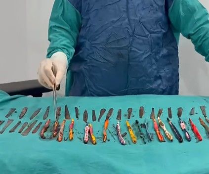 [서울=뉴시스] 복통을 호소하며 병원으로 찾아온 한 남성의 위장에서 숟가락과 칫솔 등 무려 50개의 이물질이 발견되는 충격적인 사건이 벌어졌다. (사진=유튜브 채널 'Shyam vlogs' 갈무리) 2025.10.02 *재판매 및 DB 금지