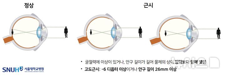 [서울=뉴시스] 근시와 고도근시. (사진= 서울대병원 제공)