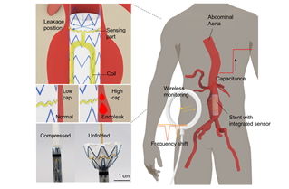 [서울=뉴시스] 연구 설명 이미지. 스텐트 근위부에 부착된 초박막 유연 센서가 혈액 유입을 감지한다. 센서 내부 LC 공진 회로에서 발생한 주파수 변화는 외부 리더기로 무선 전송된다. (사진=한양대 제공) 2025.10.02. photo@newsis.com *재판매 및 DB 금지