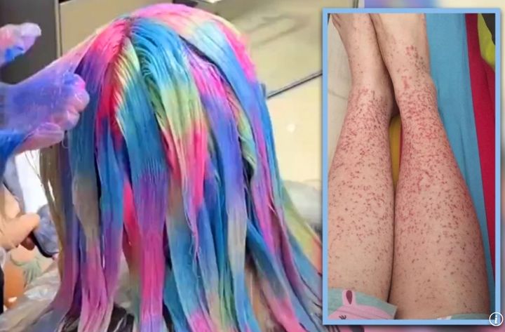 [뉴시스] K팝 아이돌을 따라 염색한 20대 여성이 신장 질환을 앓게 됐다. 2025.10.06. (사진=SCMP 캡처). *재판매 및 DB 금지