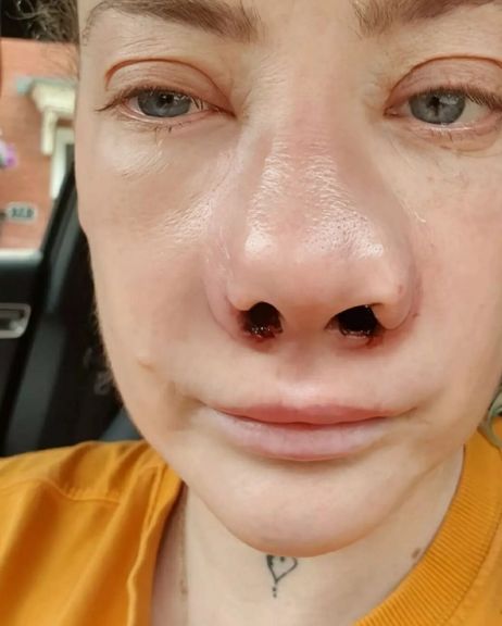 [뉴시스] 3일(현지시각) 영국 더 미러에 따르면 영국 슈롭셔주 텔퍼드에 거주하는 리앤 애비언스(41)는 최근 튀르키예에서 치아 미용 시술인 베니어 시술을 받은 뒤 괴사성 근막염에 걸려 코가 무너지고 잇몸에 감염이 퍼지는 치명적인 후유증을 겪었다. (사진=더 미러 캡처) 2025.10.8 *재판매 및 DB 금지