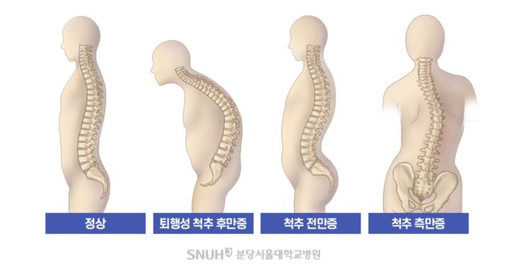 [서울=뉴시스] 15일 의료계에 따르면 척추전만증이라 함은 정상적으로 존재하는 허리뼈의 전만(앞으로 볼록하게 굽은 척추 배열 양상)이 병적으로 증가된 상태를 말한다. (사진=분당서울대병원 제공) 2025.10.15. photo@newsis.com *재판매 및 DB 금지