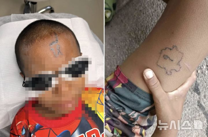 [뉴시스] 태국에서 한 초등학생이 동급생에 의해 이마와 팔다리에 강제로 문신이 새겨지는 충격적인 사건이 발생했다. (사진=더선) 2025.10.15 