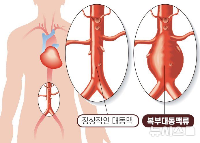 [서울=뉴시스] 복부 대동맥류 이미지. (사진= 강동경희대학교병원 제공)