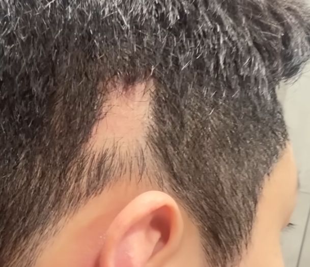 [뉴시스] 남성 유튜버 '준돌'이 귀 필러 시술을 받은 후 심각한 탈모 부작용을 겪었다고 고백했다. (사진 = '준돌' 유튜브 캡처) 2025.10.21. *재판매 및 DB 금지