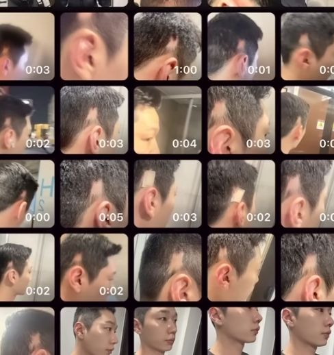 [뉴시스] 유튜버 '준돌'이 필러 시술 후 생긴 탈모를 기록한 모습. (사진 = '준돌' 유튜브 캡처) 2025.10.21. *재판매 및 DB 금지