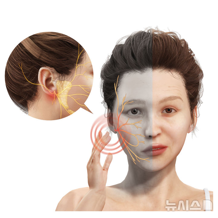[서울=뉴시스] 안면신경마비는 얼굴의 표정을 담당하는 안면신경의 기능 장애로 발생하며, 얼굴 근육의 움직임 감소로 비대칭이 나타난다. (사진= 유토이미지 제공)