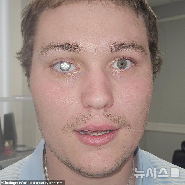 [서울=뉴시스] 다이아몬드를 삽입해 인공 눈을 디자인한 23세 영국 남성 슬레이터 존스의 모습(사진=데일리메일) 2025.10.20. 