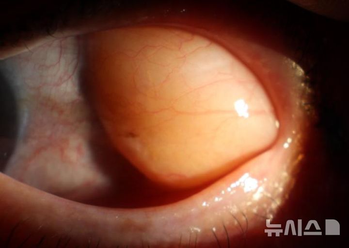 [서울=뉴시스] 눈의 노화로 결막이 약해지면서 지방이 앞으로 밀려나오는 안와지방탈출이 발생할 수 있다. (사진= 김안과병원 제공)