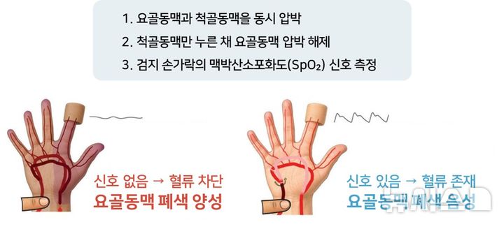 [서울=뉴시스] 영유아 요골동맥 폐색 검사법. (사진= 서울대병원 제공)