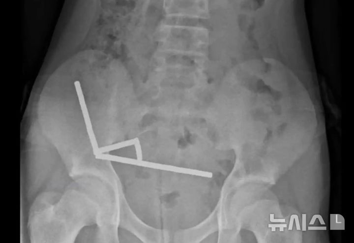 [뉴시스] 엑스레이 촬영 결과 자석이 장 내에서 뭉쳐 인근 조직의 혈류를 차단한 것으로 나타났다. (사진=뉴욕포스트) 2025.10.24. 