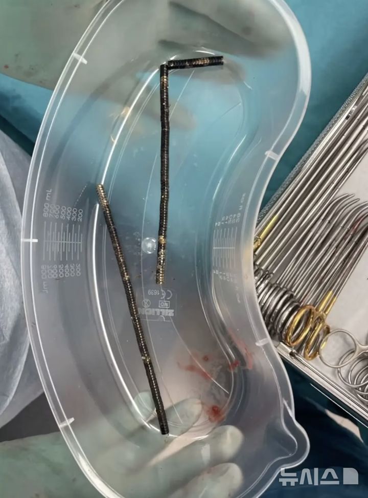 [뉴시스] 뉴질랜드 소년의 장에서 200여 개의 소형 네오디뮴 자석이 제거됐다. (사진=뉴욕포스트) 2025.10.24 