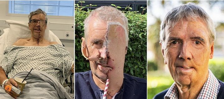 [서울=뉴시스]자전거 사고로 얼굴 반쪽을 잃은 영국 남성 데이브 리차즈(75)가 3D프린팅 보형물로 사라진 반쪽 얼굴을 덮은 모습(맨 오른쪽 사진). (사진출처: 데일리메일 캡처) 2025.10.28.