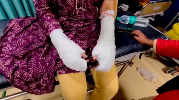 [뉴시스] 인도의 20세 여성이 자신을 스토킹하던 남성들에게 산(acid) 공격을 당했다며 경찰에 신고했는데, 알고보니 자작극이었던 것으로 드러나 현지에서 논란이 되고 있다. (사진=힌두스탄타임스 캡처) 2025.10.28 *재판매 및 DB금지 *재판매 및 DB 금지