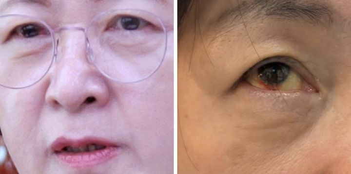 [뉴시스] 더불어민주당 소속 추미애 국회 법사위원장이 국정감사가 끝난 후 눈에 실핏줄이 터진 사진을 공개해 화제다. (사진=추미애 의원 페이스북 캡처) *재판매 및 DB금지 *재판매 및 DB 금지