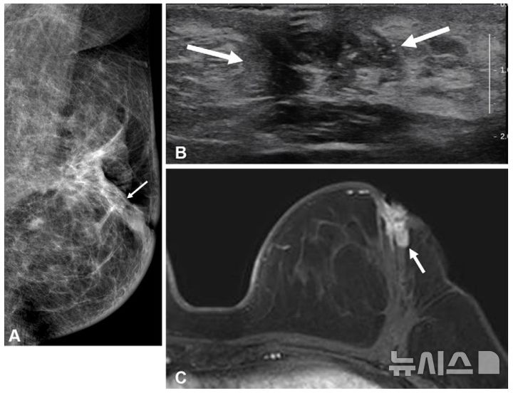 [서울=뉴시스] 수술 후 같은 측 유방 내 재발이 발생한 젊은 유방암 환자의 검사 결과. (사진= 서울대병원 제공)