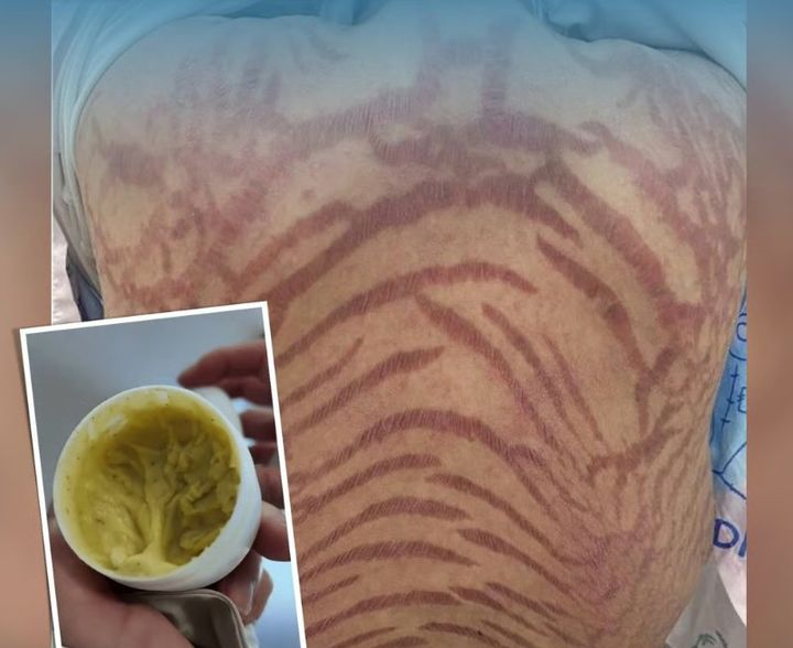 [뉴시스]중국 한 여성의 몸에 스테로이드 부작용으로 뱀 무늬를 연상케 하는 자줏빛 색깔의 무늬가 나타났다. (사진 = Douyin) *재판매 및 DB 금지
