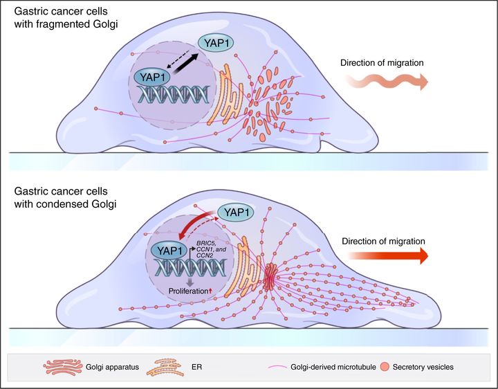 [서울=뉴시스] 11일 가톨릭대학교 의과대학에 따르면 약리학교실 김지윤 교수 연구팀은 위암 세포의 악성도가 골지체의 구조와 밀접하게 연관되어 있음을 밝혀냈다. 정상 세포에서는 골지체가 비교적 넓게 흩어져 있지만, 위암 세포에서는 오히려 골지체가 ‘응축(condensed)’된 형태로 뭉쳐있는 현상이 관찰됐다. 위암 세포 내 골지체의 응축된 구조 변형이 암 촉진 인자인 YAP1을 활성화시켜 암의 악성화를 유도하는 과정을 설명하는 모식도. (사진=가톨릭중앙의료원 제공) 2025.11.11 photo@newsis.com *재판매 및 DB 금지