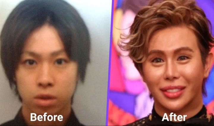 [뉴시스] 앨런의 성형수술 전과 후 사진. (사진=SCMP 캡처) *재판매 및 DB금지 *재판매 및 DB 금지