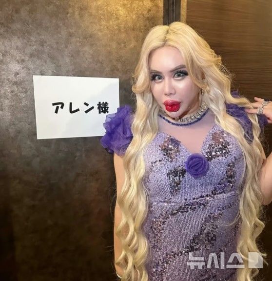 [서울=뉴시스]앨런의 성형수술 후 모습.(사진=사우스차이나모닝포스트)