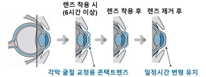 [서울=뉴시스] 식품의약품안전처는 주로 소아·청소년 등의 근시 교정에 많이 사용하는 '각막 굴절 교정용 콘택트렌즈'의 임상시험계획서 작성 가이드라인을 제정·발간한다고 17일 밝혔다. (사지=식약처 제공) 2025.11.17. photo@newsi.socm *재판매 및 DB 금지
