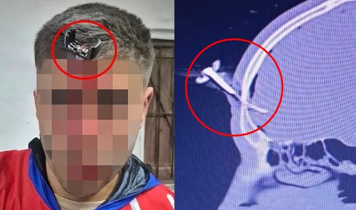 [뉴시스] 아르헨티나 축구 선수 조나단 호세 스미스(35)가 이마에 자동차 열쇠가 꽂히는 사고를 당했다. (사진=데일리메일 캡처) *재판매 및 DB 금지