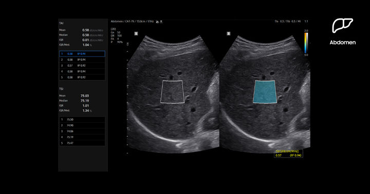 [서울=뉴시스] 삼성메디슨은 지난 9월 대한영상의학회 (KCR 2025)를 통해 영상의학과 프리미엄 초음파 진단기기 R20을 국내에 공개했다. R20은 간 지방 정량 측정 AI 기반 기능을 통해 정밀한 진단을 가능하게 한다. 티에이아이 (TAI·Tissue Attenuation Imaging)는 초음파 신호를 간세포 내 지방에 의해 약해지는 정도를 측정해 실시간으로 지방간 변화를 평가한다. (사진=삼성메디슨 제공) 2025.11.24. photo@newsis.com *재판매 및 DB 금지