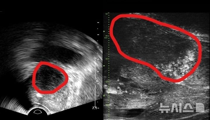[서울=뉴시스] 기존 전립선 초음파 사진(좌) 및 최신 초음파 사진. 기존 초음파는 전립선 부위(동그라미 친 부분)의 음영 차이로만 병변을 확인했지만, 마이크로 초음파는 높은 해상도를 통해 종양과 주변 조직의 모양까지 확인할 수 있다. (사진= 분당서울대병원 제공)