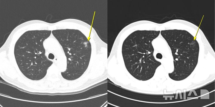 [서울=뉴시스] 무증상 일시적 면역관련 폐렴 사례. (사진= 서울대병원 제공)
