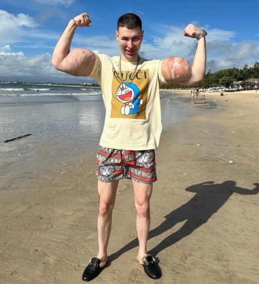 [뉴시스]종합격투기 선수인 키릴 테레신(29남)은 자신의 팔 정맥에 화학 물질인 '신톨'을 수년간 직접 주사해왔다. (사진 = kirilltereshin96 인스타그램 캡처) *재판매 및 DB 금지