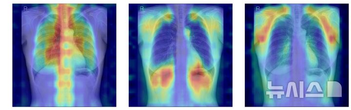[서울=뉴시스] 흉부X선에서 파운데이션 모델이 골다공증 판독을 위해 주목한 영역을 시각화한 이미지. (사진= 서울대병원 제공) 