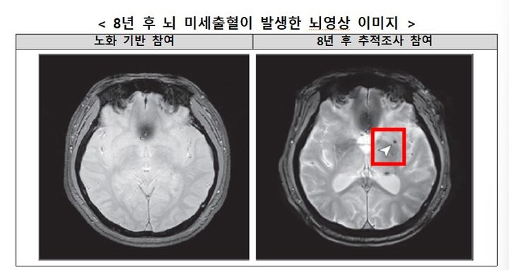 심한 수면무호흡, 뇌 미세출혈 위험 2배 높인다…중장년층 8년 추적