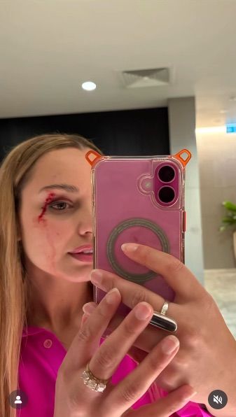 [뉴시스] 사고 이후 화장실에서 셀카를 찍은 모습. (사진=제시카 타이슨 인스타그램) 2025.12.3 *재판매 및 DB 금지